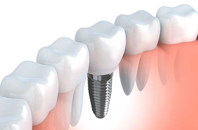 Services Dental Implants