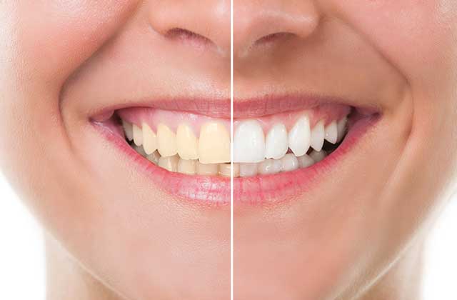 Services Teeth Whitening